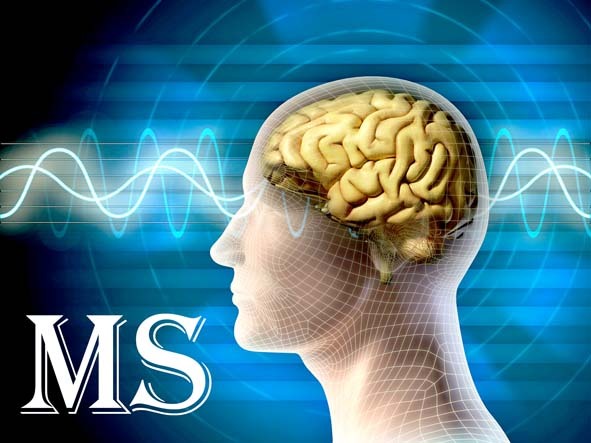 ارایه خدمات درمانی به بیش از ۸ هزار بیمار مبتلا به MS در شیراز